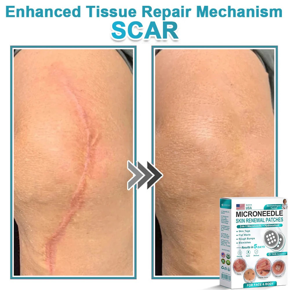 2-in-1 Microneedle & Hydrocolloid PatchšØāāļø | Removes raised moles, acne, flat warts, and skin tags